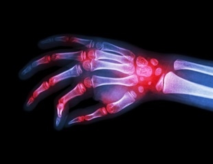 Study Reveals Tissue-Specific Effects of JAK1 Signaling in Inflammation