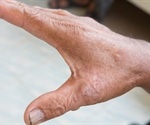 Researchers discover protein that may trigger lung scarring