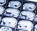 New Frontier in Understanding Brain Development and Rare Diseases