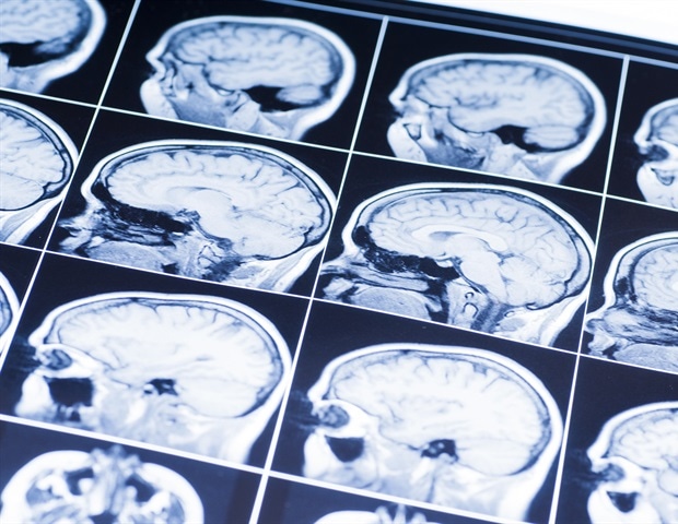 Disrupted Circadian Rhythms Alter Gene Activity in Alzheimer’s Disease