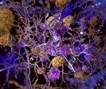 Nutritional supplement may reduce the risk of strokes caused by a rare genetic disorder