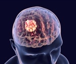 Unlocking Glucose-Driven Mechanisms of Immunosuppression in Glioblastoma