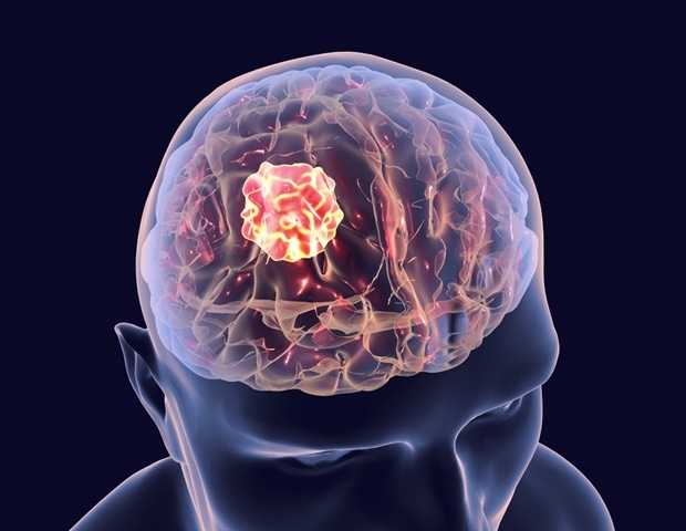 Study Details Genetic Divergence Between Astrocytomas and Oligodendrogliomas