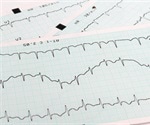 Genetic testing underutilized in patients with cardiomyopathies and arrhythmias, study says