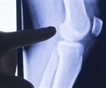 uEXPLORER TB-PET/CT scanner captures complete picture of systemic inflammatory arthritis