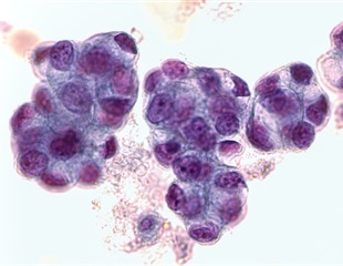 New data shows immunotherapy is beneficial for patients with gastric, esophageal cancers