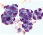 New data shows immunotherapy is beneficial for patients with gastric, esophageal cancers
