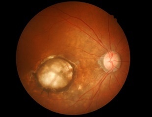 Genetically Modified iPS Cell Applications for Fabry Disease