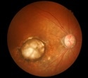 Reticular Pseudodrusen Genetics Linked to Increased AMD Risk