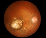 Newly Identified Rare Genetic Variants Could Point to One of the General Mechanisms Driving AMD