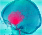 Researchers discover previously unknown genetic causes of three rare conditions
