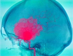 New method can enable early detection and treatment of cerebral aneurysms