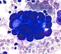 New Genomic Data Confirms a Single Pathway for Esophageal Adenocarcinoma