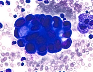 New data shows immunotherapy is beneficial for patients with gastric, esophageal cancers