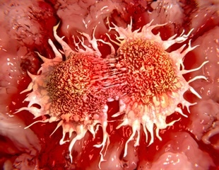 Inherited Genes Play Key Role in Cancer Development