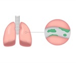 New, evidence-based guideline for treating patients suffering from NTM pathogens