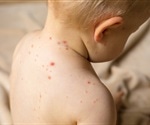 Infection with measles virus activates two different immune responses