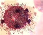 Lipid Peroxidation in Lysosomes Unleashes Ferroptosis in Tumors