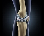 Measurement of plasma D-dimer levels can be useful when diagnosing periprosthetic joint infection
