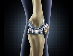 Measurement of plasma D-dimer levels can be useful when diagnosing periprosthetic joint infection