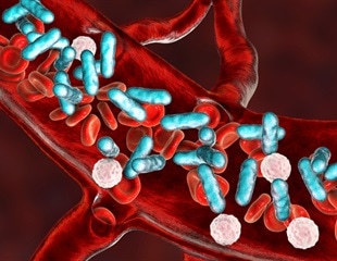 Electrochemical sensor for rapid detection of multiple sepsis biomarkers in whole blood