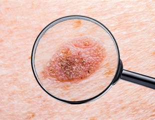 Innovative Genomic Technology Uncovers Mechanisms of Marjolin's Ulcer