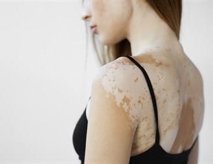 Basement Membrane Remodeling Drives Melanocyte Dedifferentiation in Vitiligo Skin Lesions