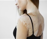 Basement Membrane Remodeling Drives Melanocyte Dedifferentiation in Vitiligo Skin Lesions