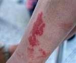 Scientists identify a genetic basis for ANCA-associated vasculitis