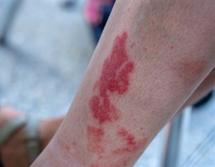 Scientists identify a genetic basis for ANCA-associated vasculitis