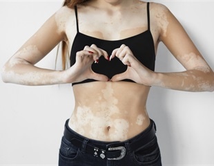 Basement Membrane Remodeling Drives Melanocyte Dedifferentiation in Vitiligo Skin Lesions