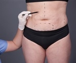 Bariatric surgery may change gene expression in fat tissue