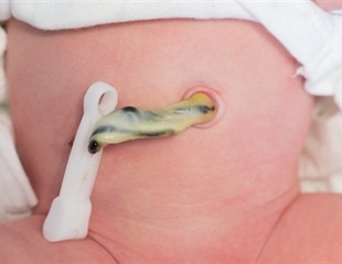 Umbilical cord blood treats children born with non-cancerous genetic disorders