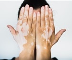 Basement Membrane Remodeling Drives Melanocyte Dedifferentiation in Vitiligo Skin Lesions