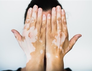 Basement Membrane Remodeling Drives Melanocyte Dedifferentiation in Vitiligo Skin Lesions