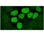 Researchers propose new way to exploit the weaknesses of cancer cells