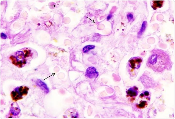 Researchers probe the mechanisms of COVID-19 linked to impaired erythrocytes