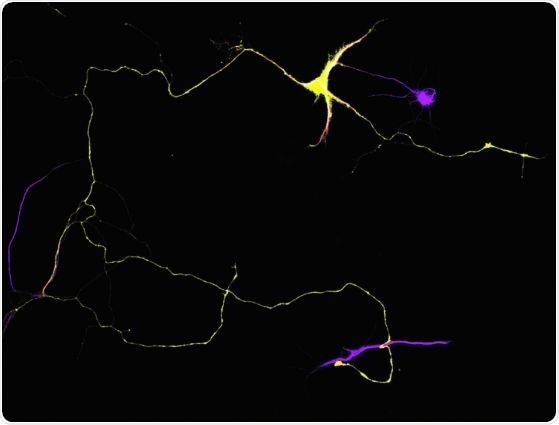 Study identifies molecular mutation more common in African Americans with late-onset Alzheimer’s