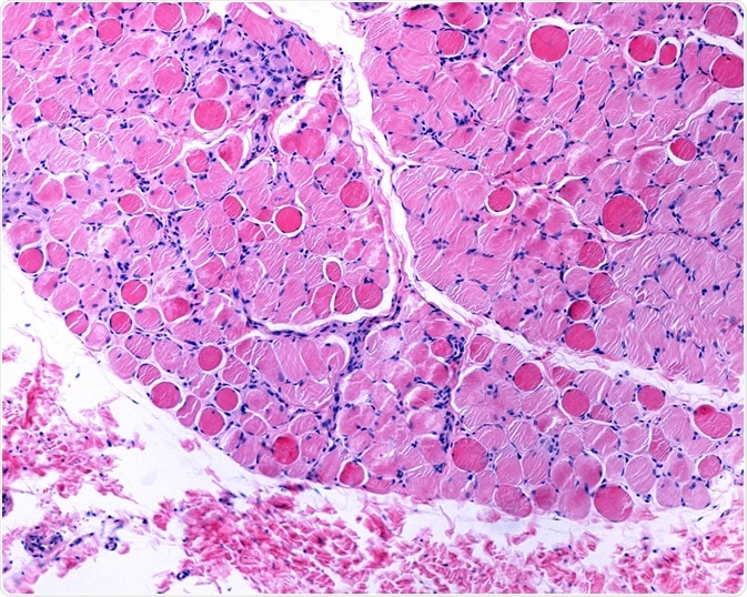 Duchenne muscular dystrophy Duchenne muscular dystrophy