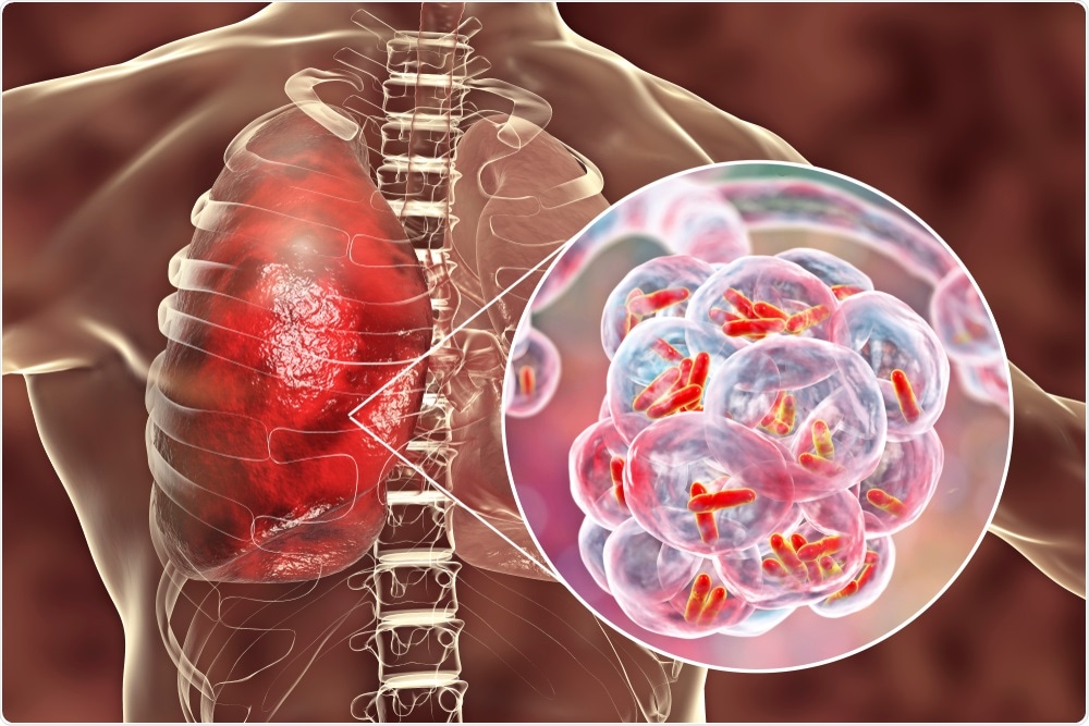Bacterial Pneumonia