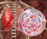 Gaining new insights into bacterial pneumonia