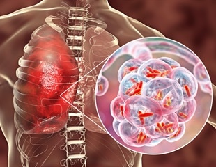 Gaining new insights into bacterial pneumonia