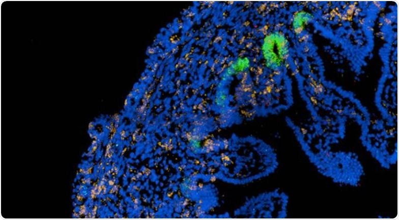 Specific cellular pathways in the fetal gut may reactivate Crohn’s Disease