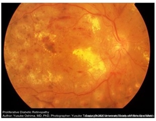 Researchers discover genetic factors underlying diabetic retinopathy