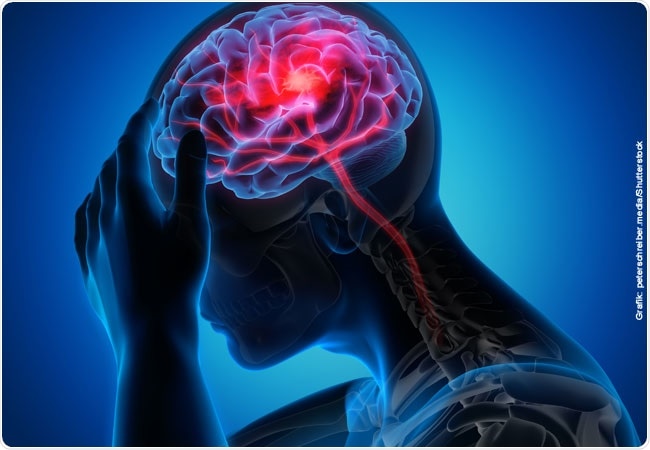 Study shows tRNA fragments play a key role in ischemic stroke