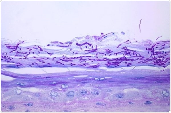 Dermatophytes (T. rubrum)—Antifungal effect in colonization of Labskin by Dermatophytes.
