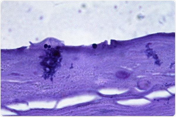 Malassezia globosa + Commensal Microflora—Antidandruff effect in colonization of Labskin with Malassezia and a commensal microbial consortium.
