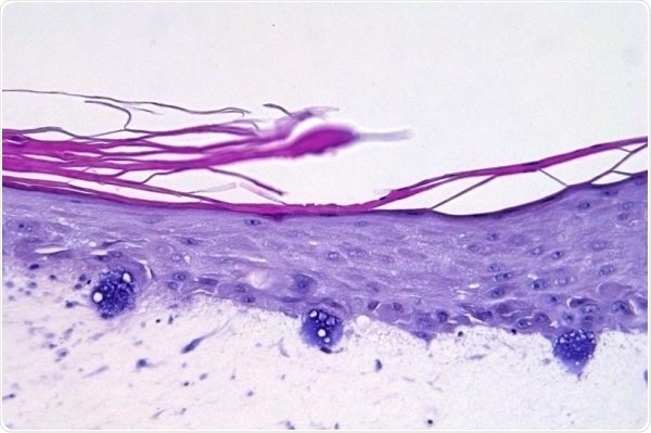 Acne vulgaris—Acne-related infection by C. acnes.