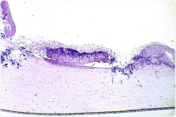 Wounds—Antiseptic/antimicrobial testing in wounds colonized by interkingdom biofilms (S. aureus + C. albicans).