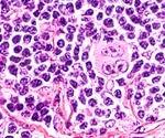 Study reveals significant neighborhood preferences of tumor cells in Hodgkin lymphoma